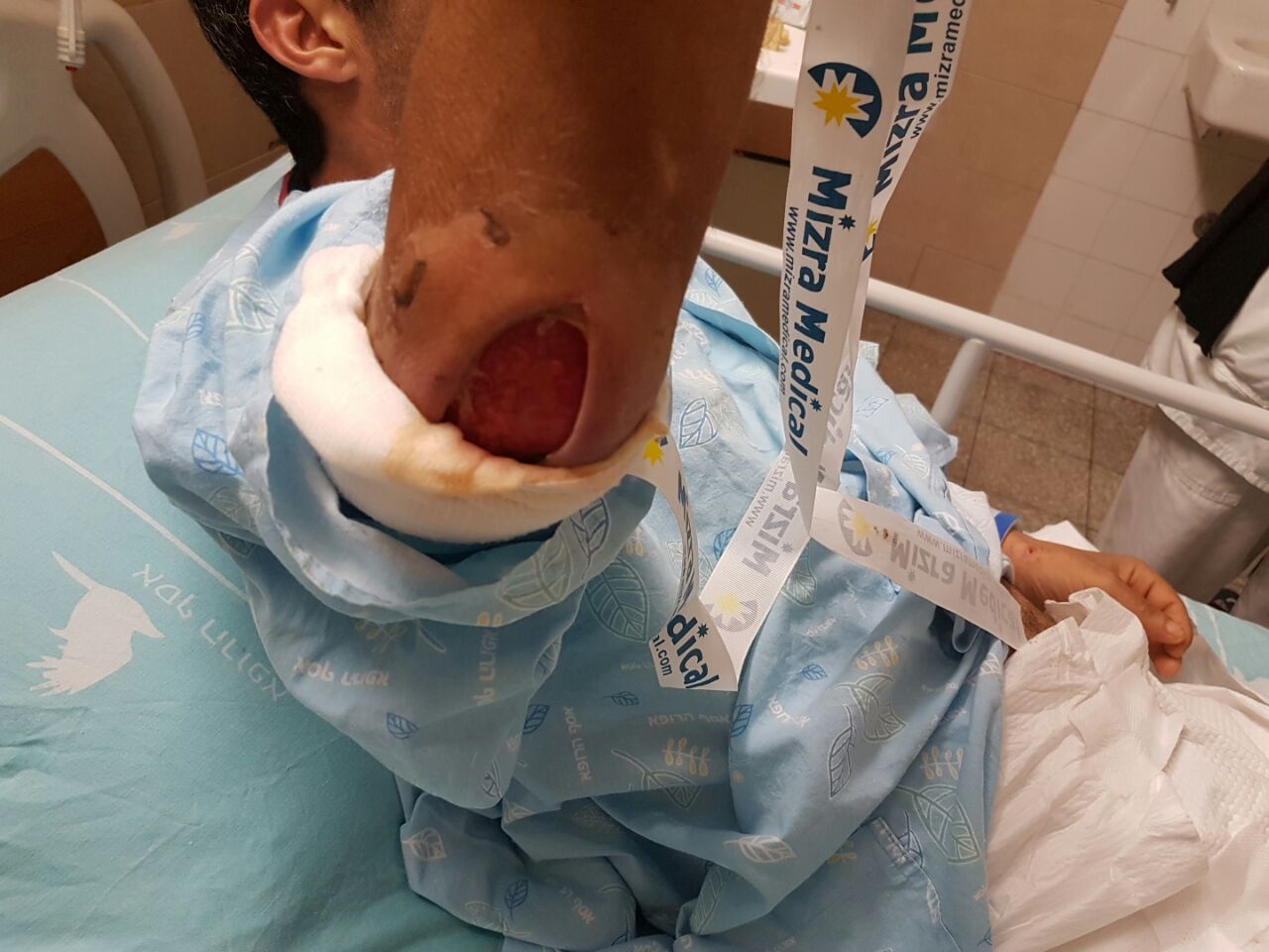 מרפקו של גבריאל. יזדקק להתשלת עור (צילום: באדיבות המשפחה)